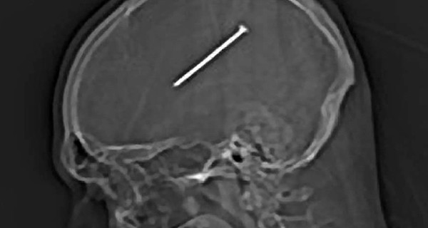 Мужчина пробил себе гвоздем голову и продолжил ремонт