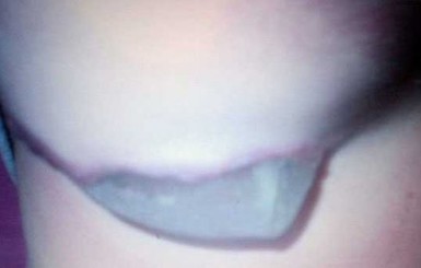 Силикон продырявил американке грудь