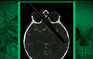 Афганец чудом прожил 15 лет с карандашом, торчащим из головы