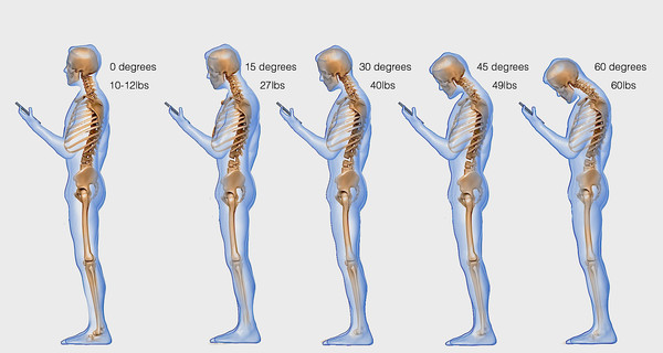 Доктора бьют тревогу: смартфоны приводят к заболеваниям позвоночника