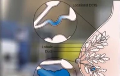 Британские ученые нашли лекарство от рака груди у женщин в возрасте