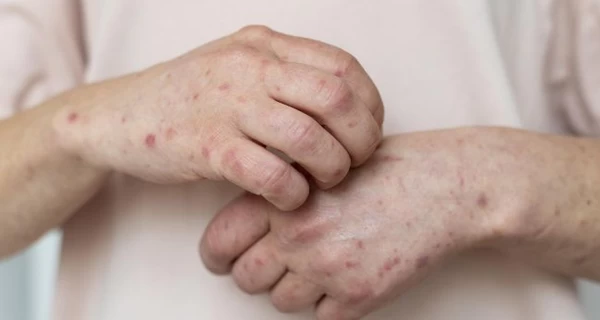 В Украине растет заболеваемость корью и ситуация может усложниться, - Центр общественного здоровья  