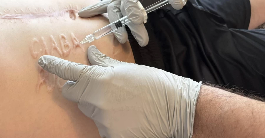 Українському військовому, звільненому з полону, почали видаляти надпис на тілі 
