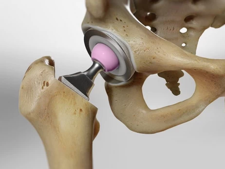 Не тільки вік: чому кульшовий суглоб доводиться міняти і в 30, і в 60 років