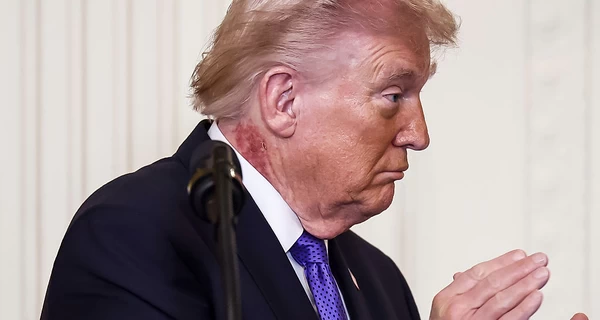 Лікар Трампа пояснив, звідки на його шиї великі червоні плями 