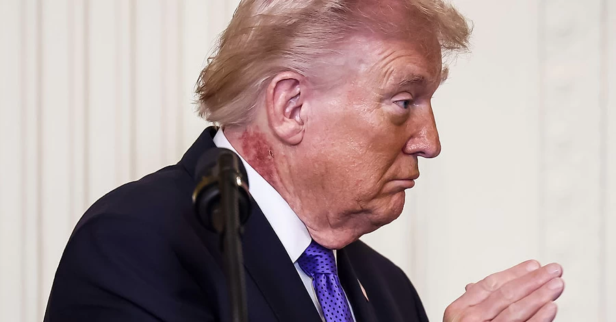 Врач Трампа объяснил, откуда на его шее большие красные пятна