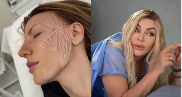 Красота будущего: Билык установила импланты для энергии, а Никитюк делает уколы для стимуляции коллагена 