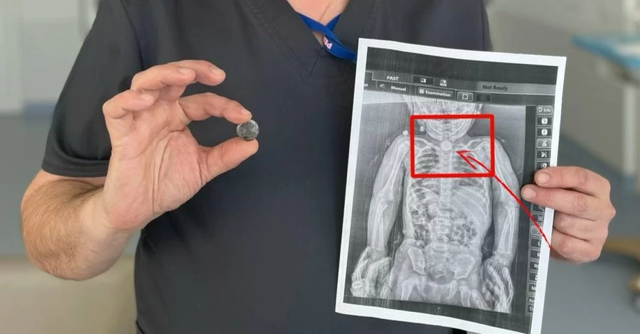 Львовские хирурги спасли 2-летнюю девочку, всю зиму прожившую с батарейкой в ​​пищеводе