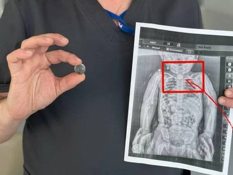 Львовские хирурги спасли 2-летнюю девочку, всю зиму прожившую с батарейкой в ​​пищеводе